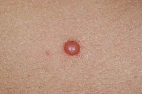 Виды папилломы, хаpaктер заболевания, лечение народными методами 