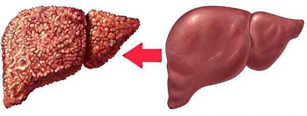 Гепатоз печени: причины, симптомы и лечение 