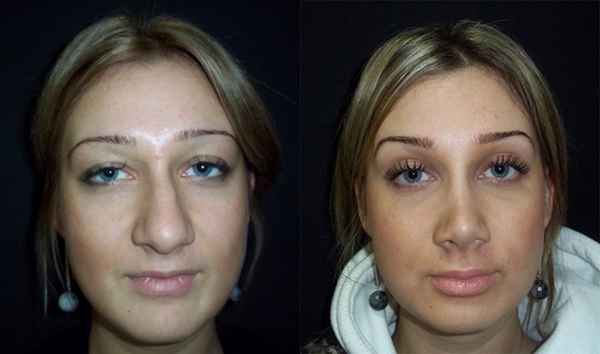 Ринопластика: до и после, безоперационная, отзывы после операции 