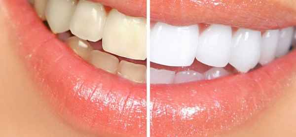 ТОП лучших средств для отбеливания зубов 