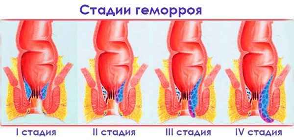Геморрой: как избежать осложнений и облегчить течение болезни 