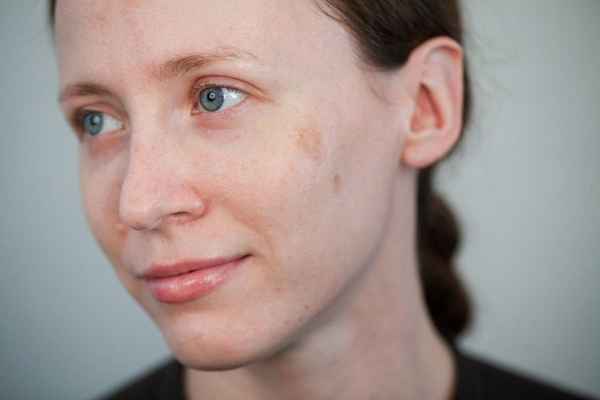 Розацеа на лице: лечение, симптомы, причины, как лечить 