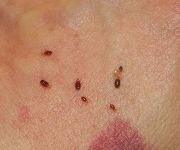 Укусы клопов: как выглядят, лечение, симптомы 