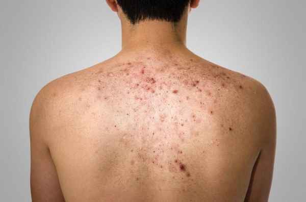 Прыщи на спине, причины 