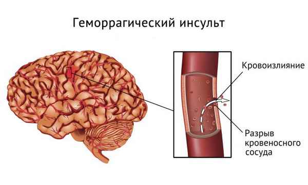 Инсульт причины и лечение методы лечения предупреждения 