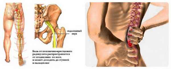 Как лечить радикулит? способы лечения радикулита 