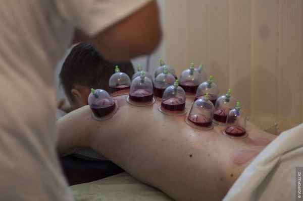 ПроцеДypa хиджама, её воздействие на организм, методика 