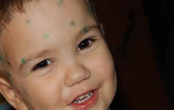 Чем лечить ветрянку у детей 