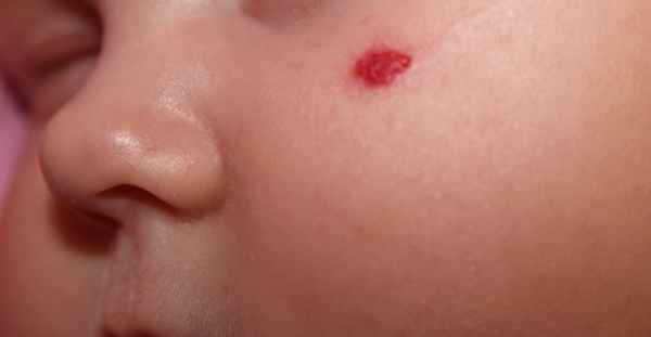 Гемангиома: классификация, причины, клиника, лечение 