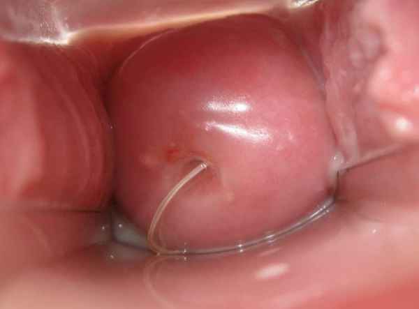 Эктропион: причины, диагностика, лечение 