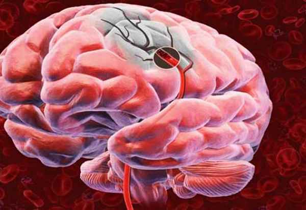 Что такое инсульт? Меры по профилактике инсульта 