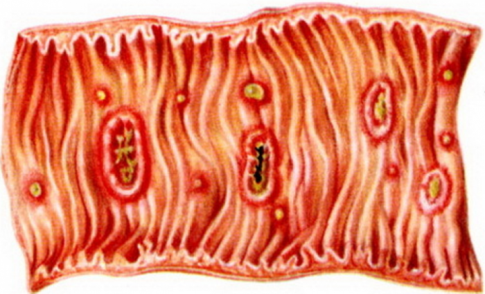 Амебиаз: основные симптомы и методы лечения 