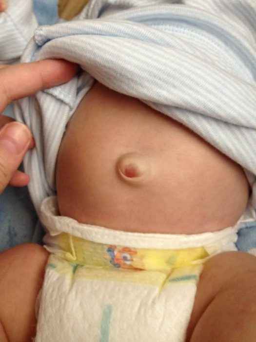 Способы лечения пупочной грыжи у ребёнка, признаки 