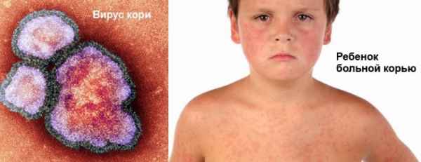 Корь: лечение и профилактика кори 