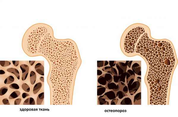Остеопороз, как лечить 