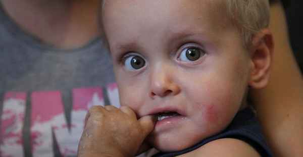 Болезни детей: &laquo;синдром бабочки&raquo;, что это и как лечить? 