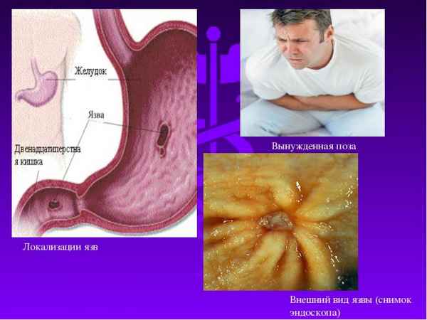 Как происходит процесс образования язвы и в чем заключается диагностика 