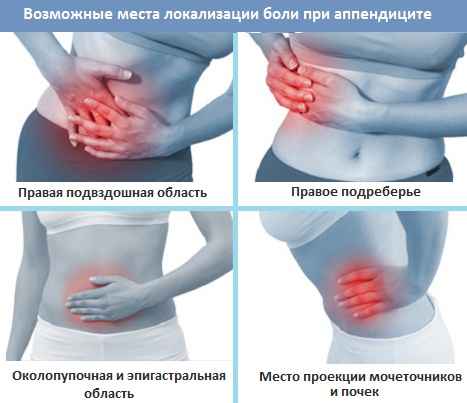 Аппендицит симптомы и признаки, воспаление, симптом, лечение 