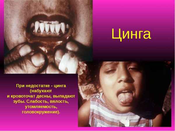 Цинга у детей: симптоматика, лечение и профилактика 