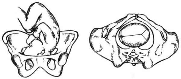 Раскрытие таза в родах 