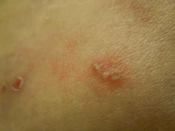 Болезни новорожденных: сифилиды при наследственном сифилисе 