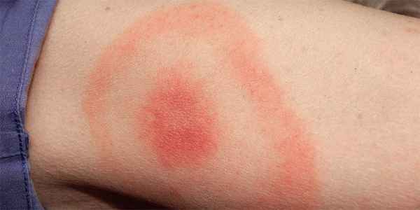 Боррелиоз (болезнь Лайма): путь заражения, стадии и симптомы 