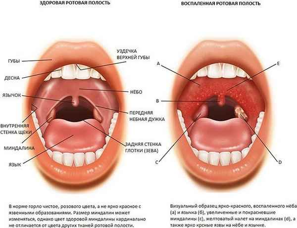 Детские болезни: тонзиллит или ангина, как определить 