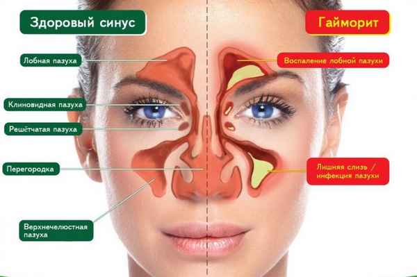 Лечение гайморита насморк симтоматика 