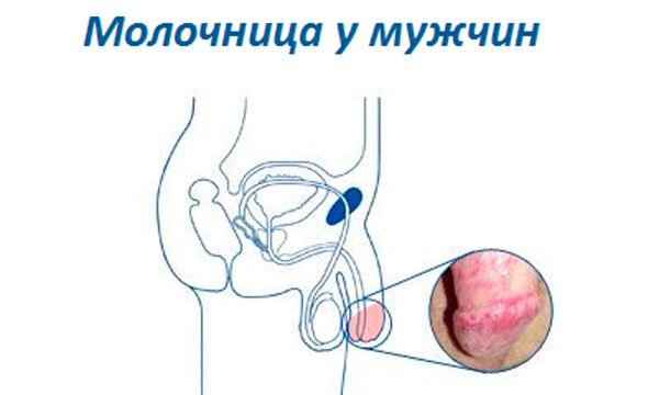 Хроническая молочница 