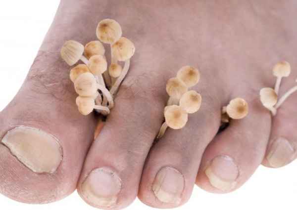 Лечение микоза стоп в домашних условиях 