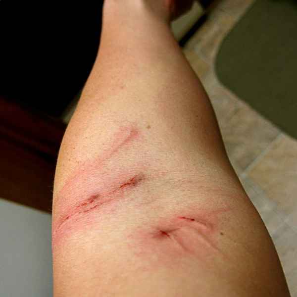 Фелиноз (болезнь кошачьей царапины): возбудитель, пути передачи 