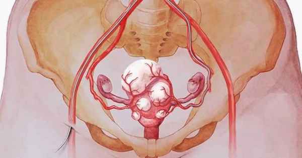 Миома матки, симптомы 