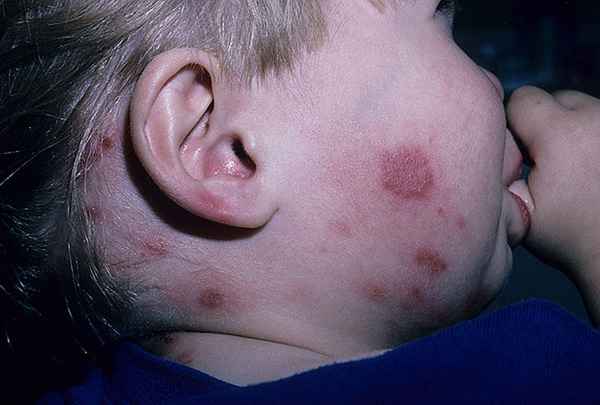 Лишай у детей — как выглядит, симптомы, стригущий, опоясывающий 