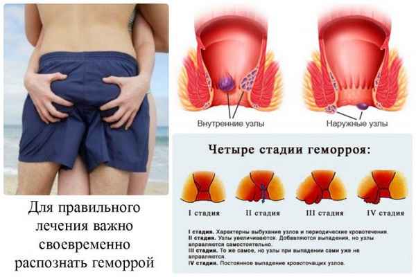 Как лечить геморрой 
