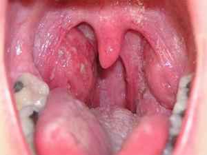 Абсцесс горла и гортани: что это такое, симптомы, классификация