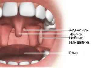 Аденоиды: что это такое, симптомы у детей, признаки воспаления, причины