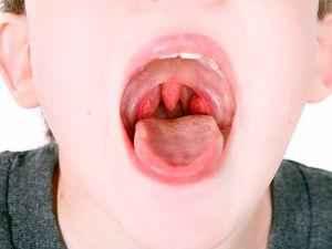 Гипертрофия аденоидов 1, 2, 3 степени: что это такое, симптомы, лечение