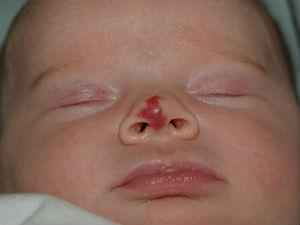 Гемангиома носа, гортани и полости рта: причины, симптомы, лечение