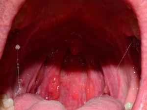 Гранулезный фарингит: лечение, симптомы и причины