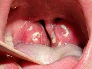 Гнойный тонзиллит: лечение, причины возникновения, диагностика