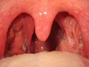 Фарингит и тонзиллит: лечение, чем отличаются, основные отличия