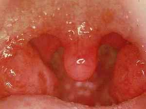 Сифилитическая ангина: причины, симптомы и лечение