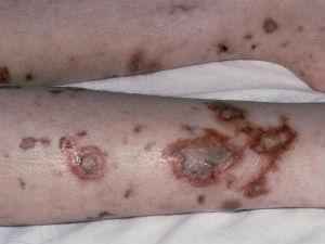 Сыпь при менингите у детей: особенности таких высыпаний