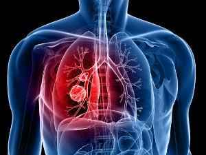 Кашель при paке легких: лечений, какое тип кашля бывает