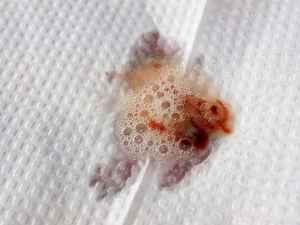 При кашле мокрота с кровью: возможные причины, лечение