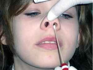 Maзoк из зева и носа на стафилококк, эозинофилы, дифтерию и инфекции