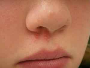 Ранка в носу не заживает: причины и лечение, чем лечить раны