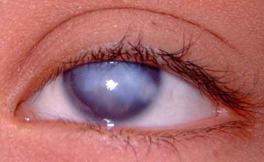 Сонник Бельмо, к чему снится Бельмо во сне видеть