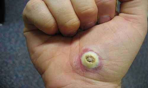 Сонник Бородавка, к чему снится Бородавка во сне видеть