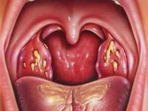 Лечение тонзиллита в домашних условиях, как его лечить дома